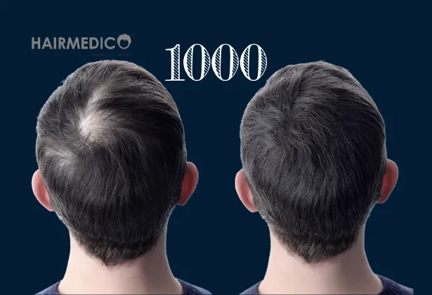 1000 greffes de cheveux avant et après 2025