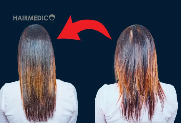 2000-greffes-de-cheveux-avant-après-2025