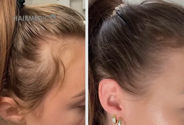 2500 greffons de greffe de cheveux avant et après 2025