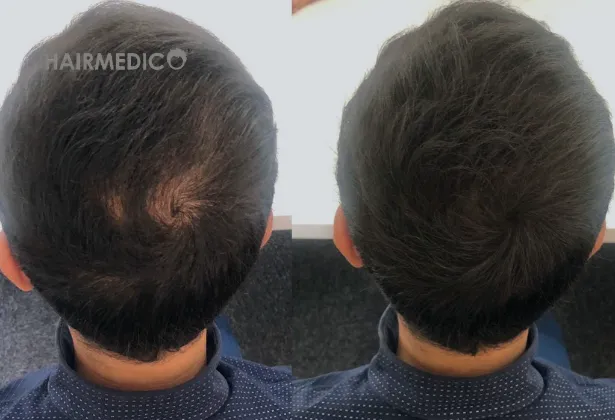 3000 greffons de greffe de cheveux avant et après 2025