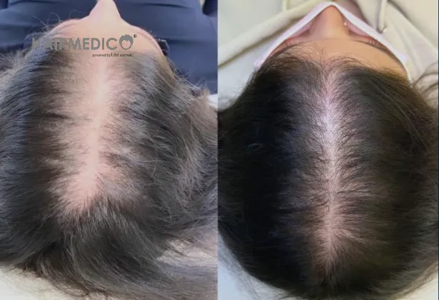3000 greffes de cheveux avant et après 2025