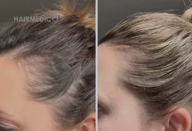 4 500 greffons de greffe de cheveux avant et après 2025