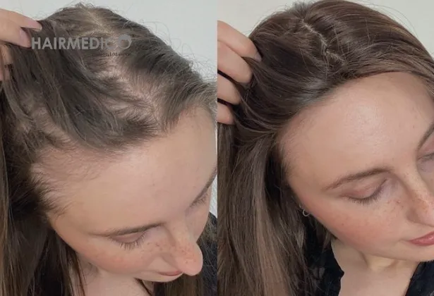 500 greffes de cheveux avant et après 2025
