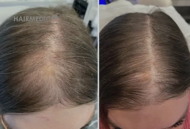 5000 greffons de greffe de cheveux avant et après 2025