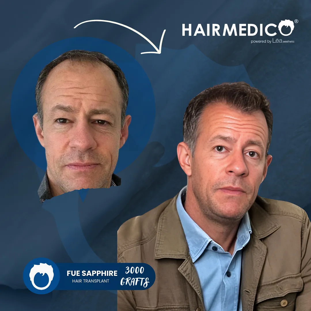 Best Hair Transplant Clinic in the World | Top-Rated Hair Restoration Centers