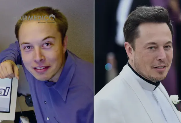Elon Musk Before Hair Transplant 2025
