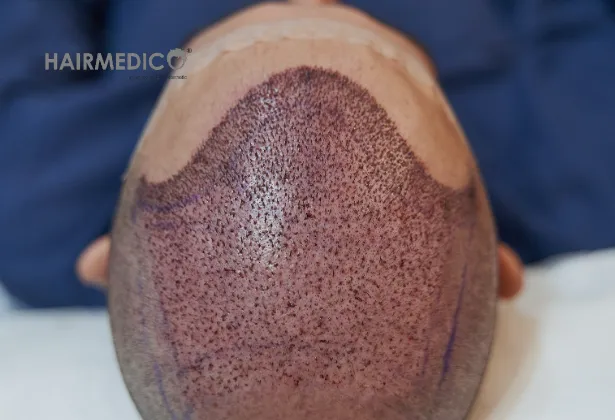 Technique de Greffe de Cheveux Sapphire FUE 2025