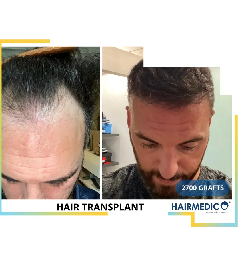 hair transplant without shaving in turkey at hairmedico price and review