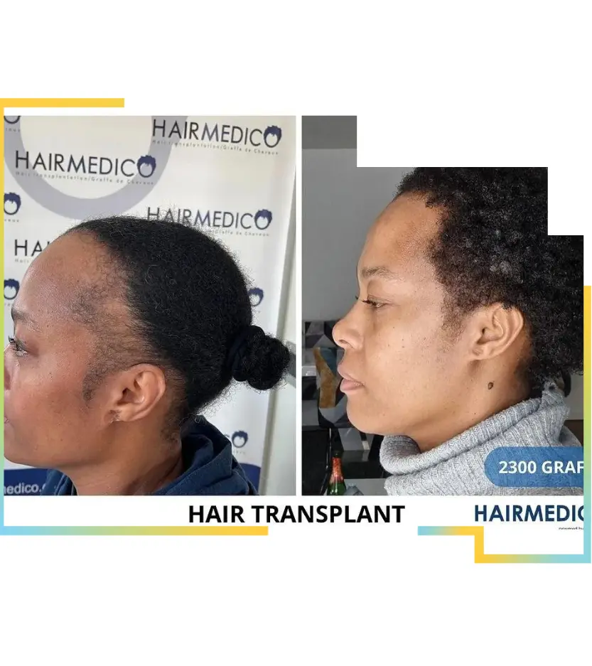 afro female hair transplant in turkey at hairmedico price , review