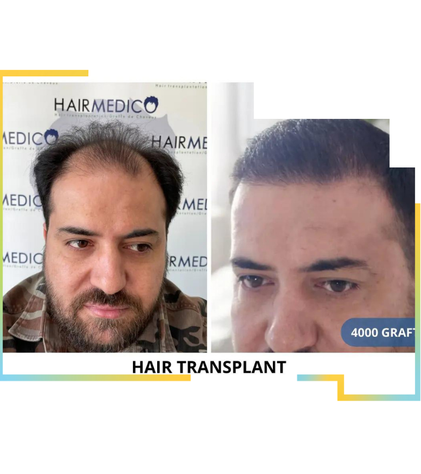 FUE Hair transplant in turkey at hairmedico price and review