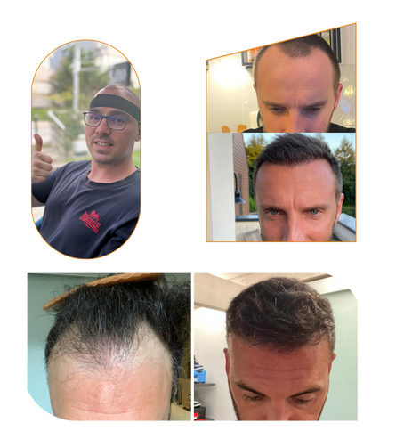 DHI Hair transplant in Turkey