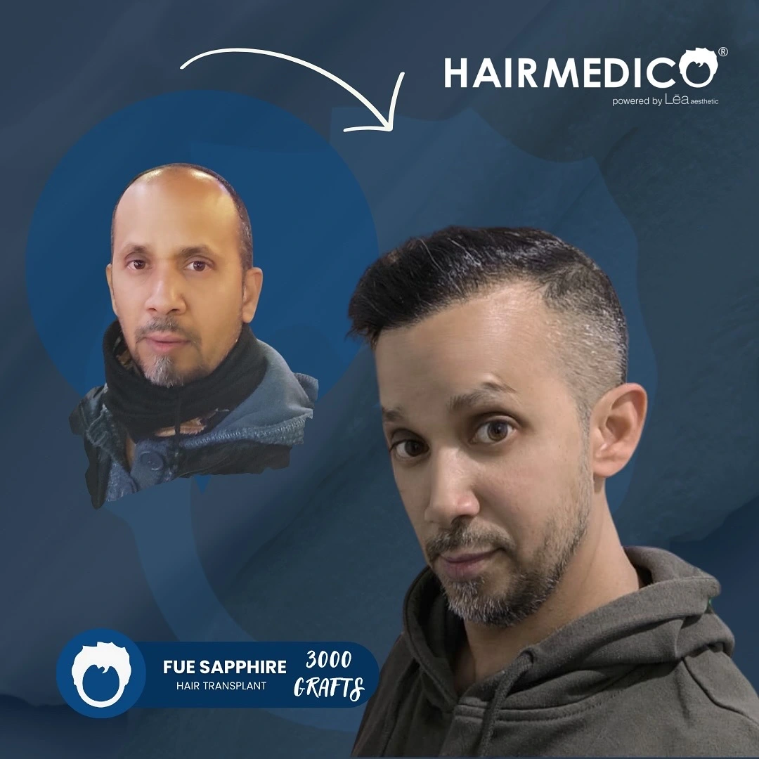 results-hair-transplantB060EAA3-E2A6-4014-8EDF-5BF4588BBE5F