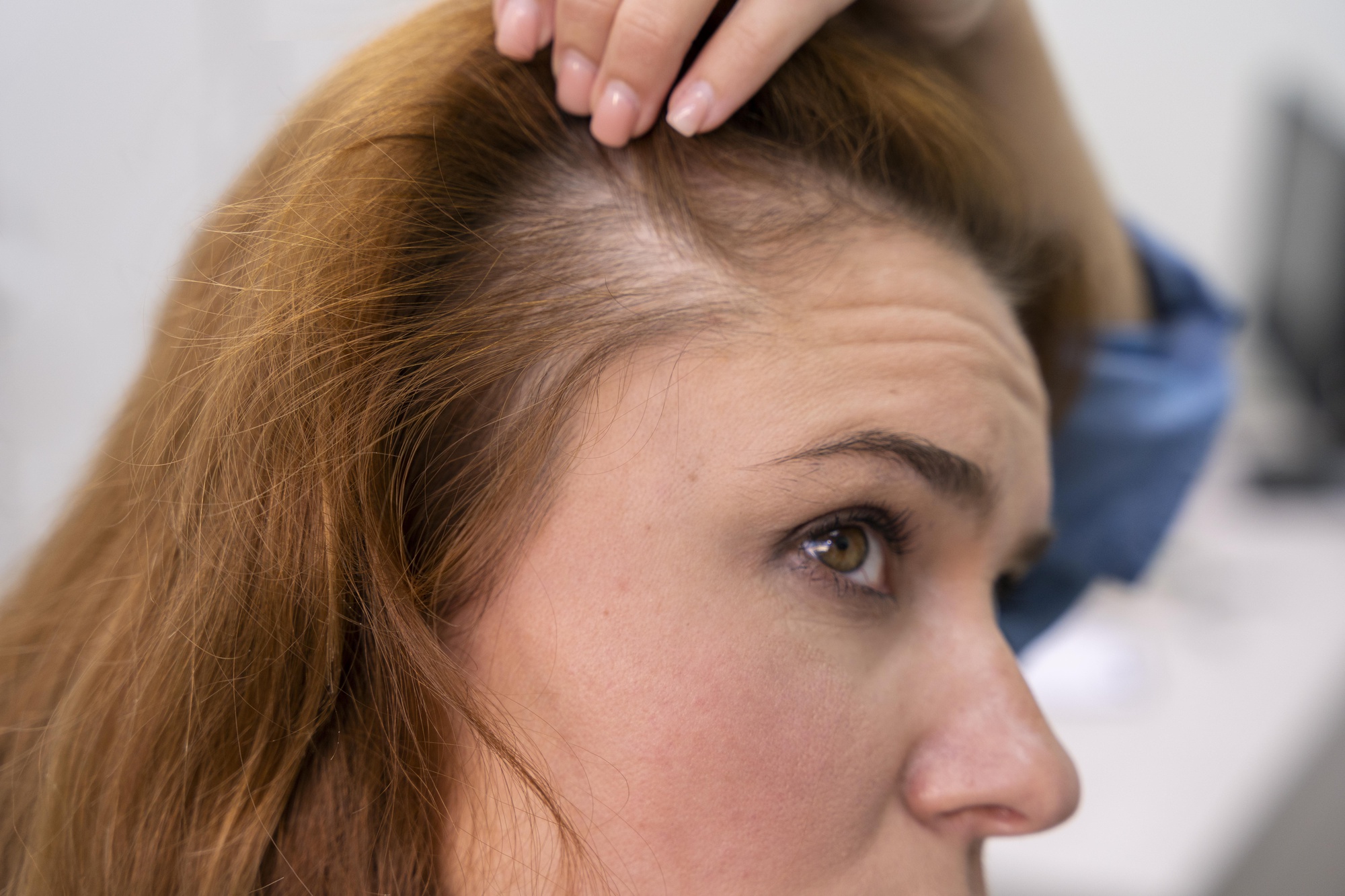 woman-getting-hair-loss-treatment-clinic